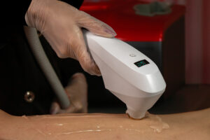 Equipamento Adélla Laser sendo aplicado em uma perna com objetivo de depilação a laser